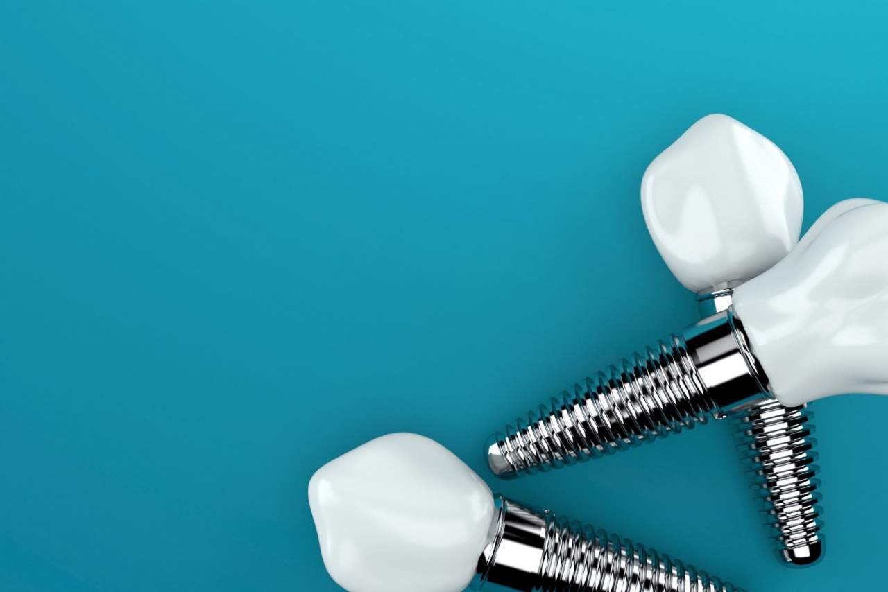 Implante dental profesional en Sevilla: Helident