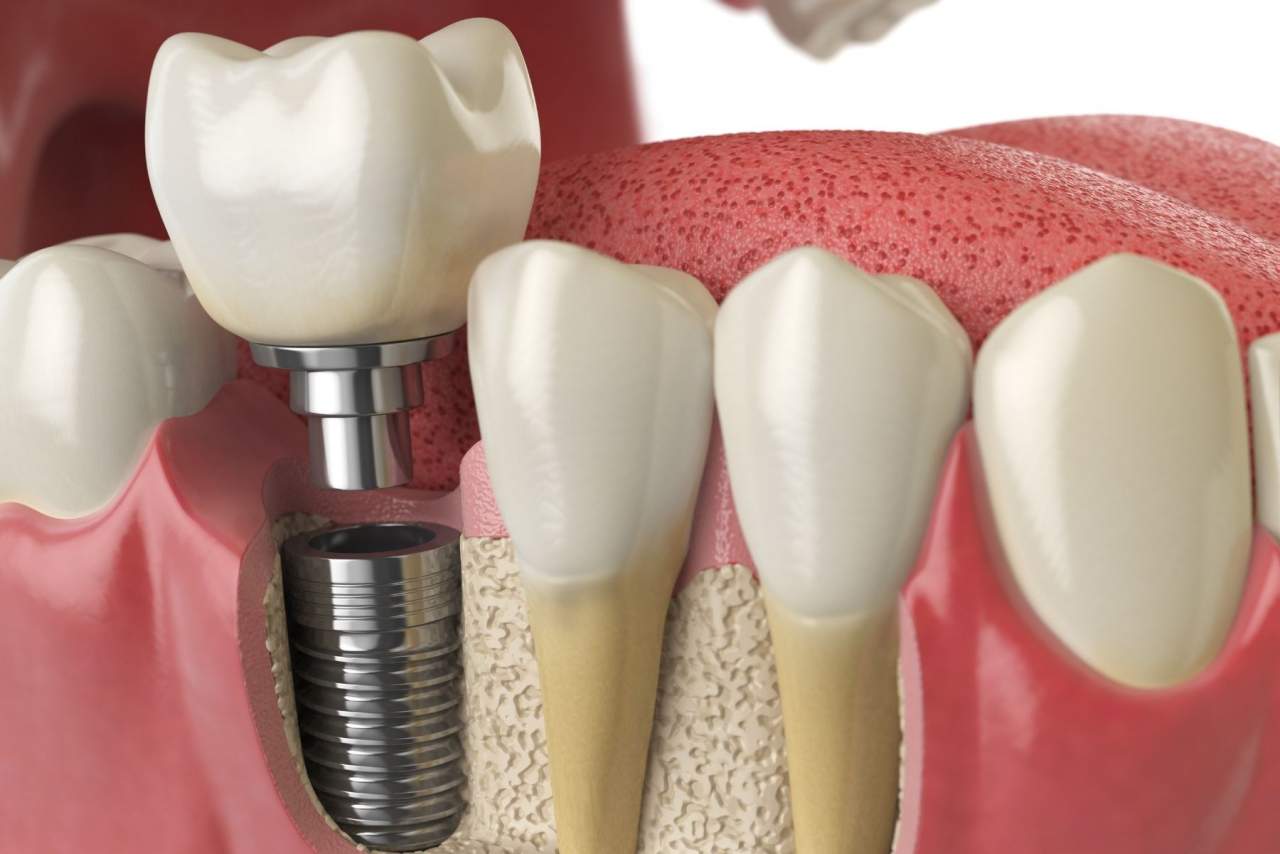 ¿Los implantes duran para siempre?¿Qué cuidados necesitan? Helident Training Center