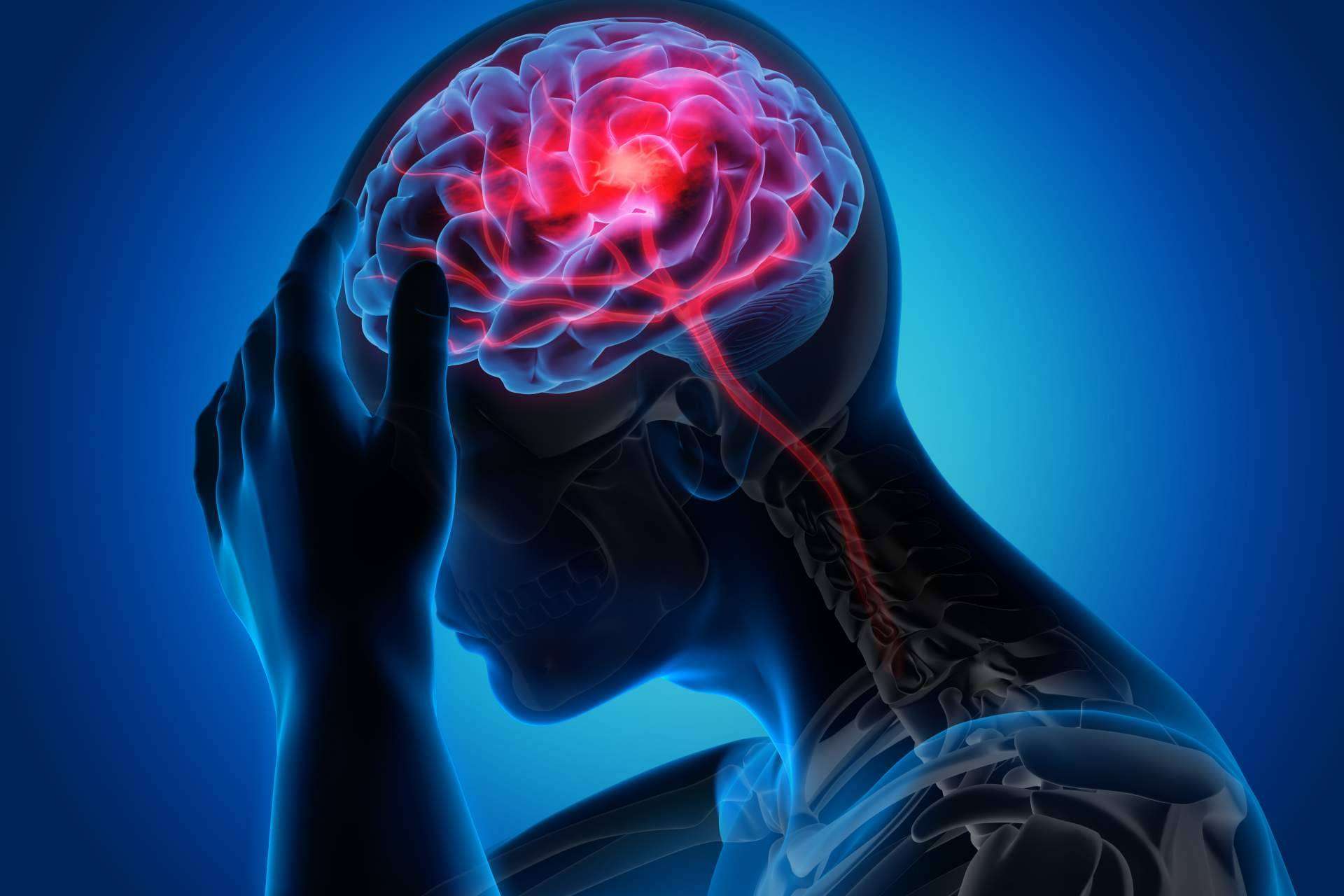 Fisioterapia para aliviar las migrañas: Clínica Viasalud