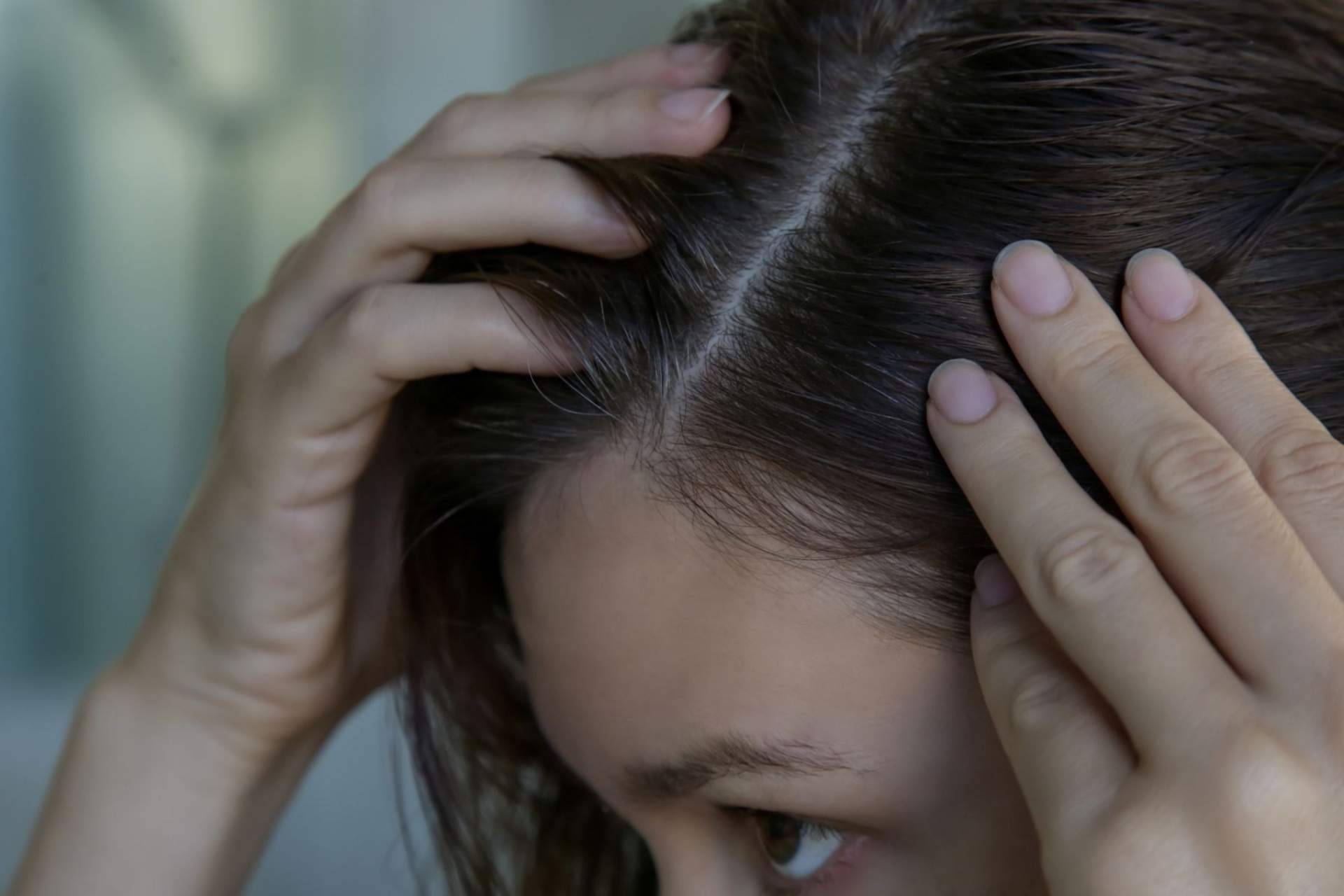 Tratamientos para combatir la descamación y caspa y lucir un pelo sano en el centro de belleza profesional CharoConector