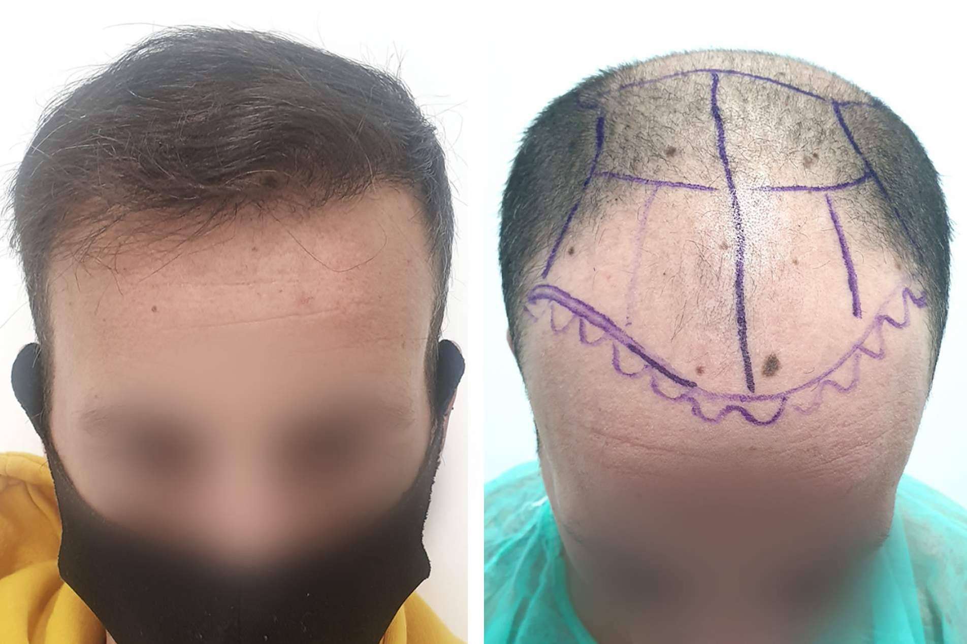 Técnica de injerto capilar sin cicatriz en Injermur