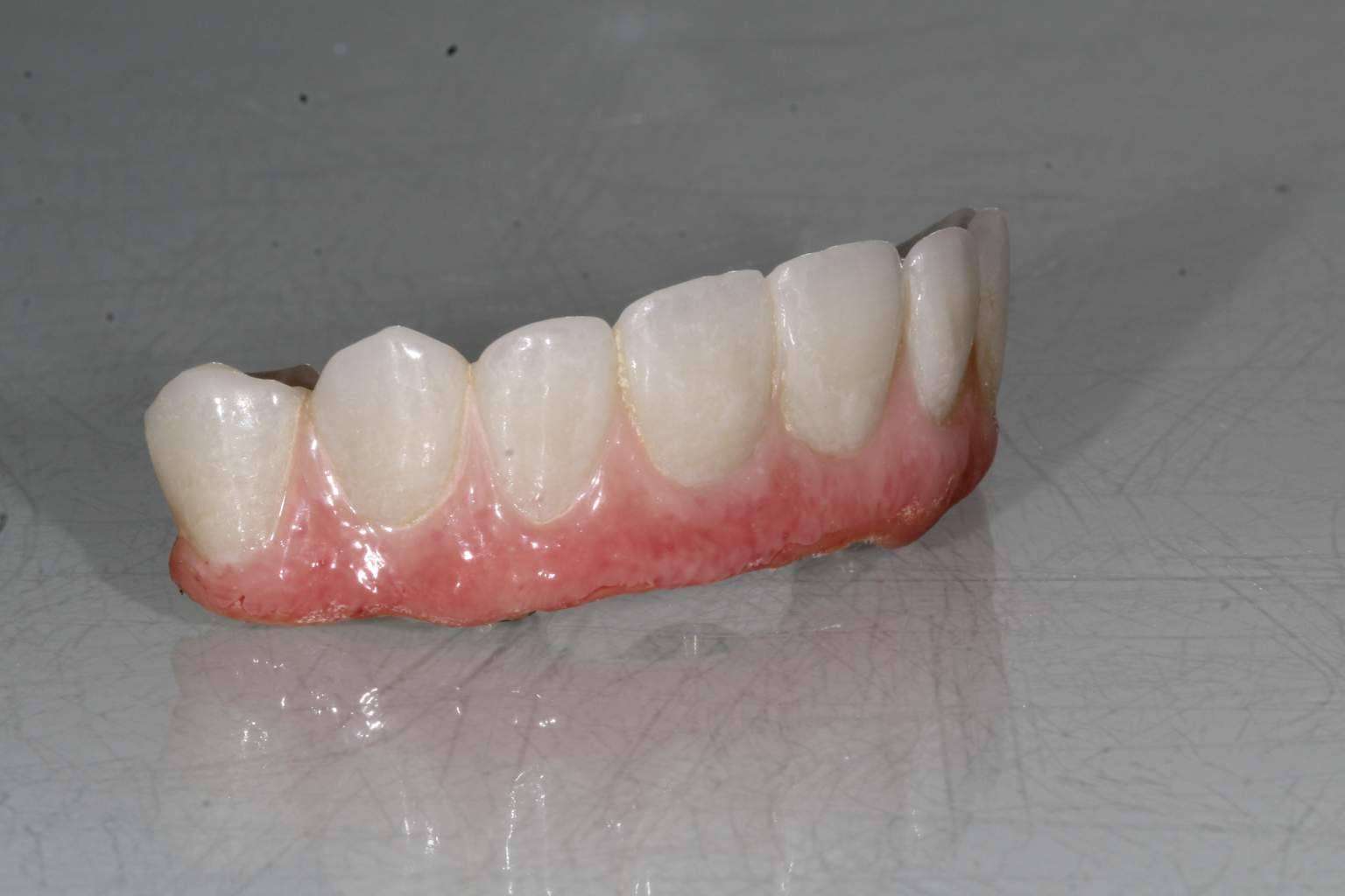 El tratamiento ALL ON 4 de Implant Clinics ¿Cuáles son sus beneficios?