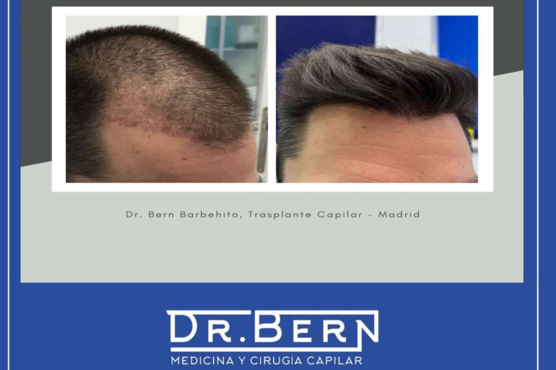 Todo lo que hay que saber acerca del postoperatorio de la cirugía capilar, de la mano del Doctor Bern