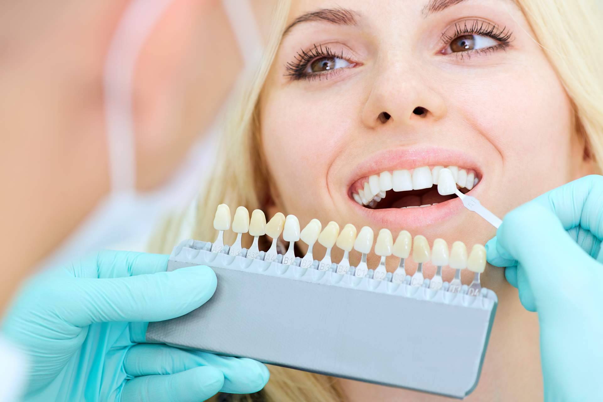 Información sobre el tratamiento de carillas dentales de esta clínica dental de Chamartín