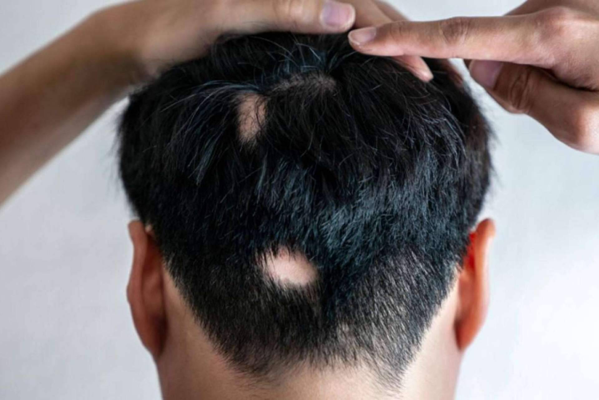 ¿Qué es la alopecia areata y cómo disimularla?