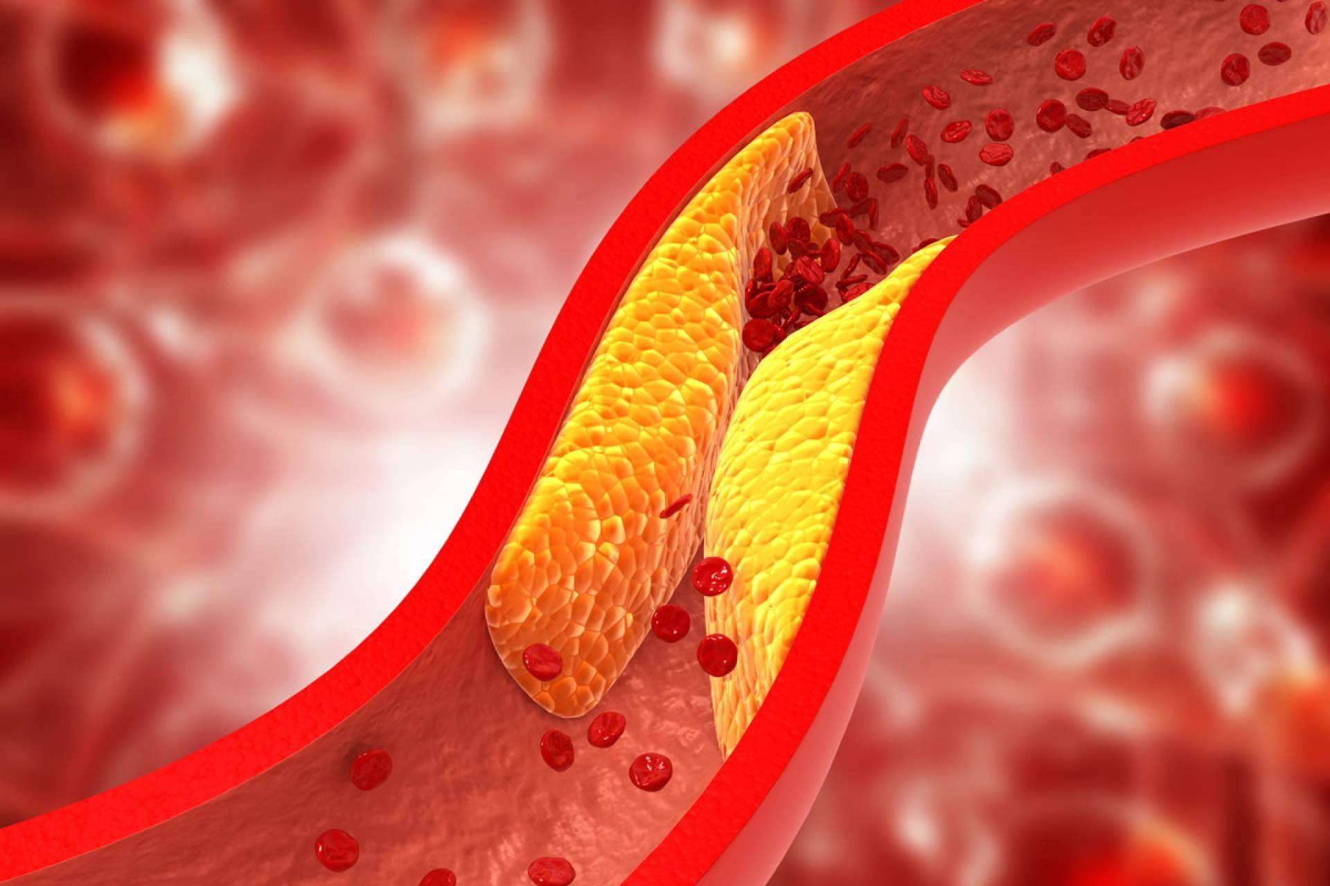 La fórmula innovadora con levadura roja de arroz rojo de Beverly Nutrition, ReduCol 25