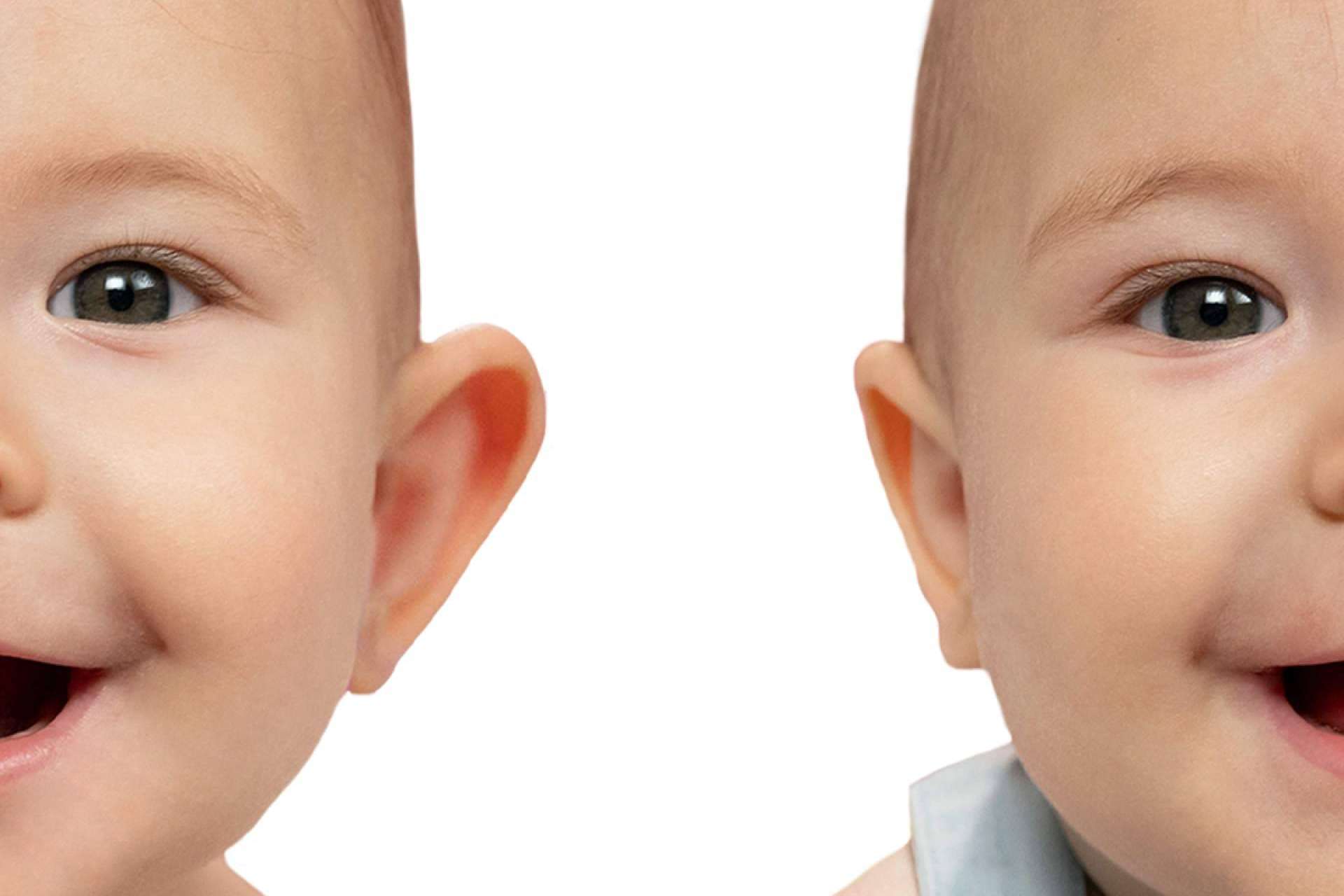 Corregir las orejas de soplillo en bebés y niños, con Otostick Bebé