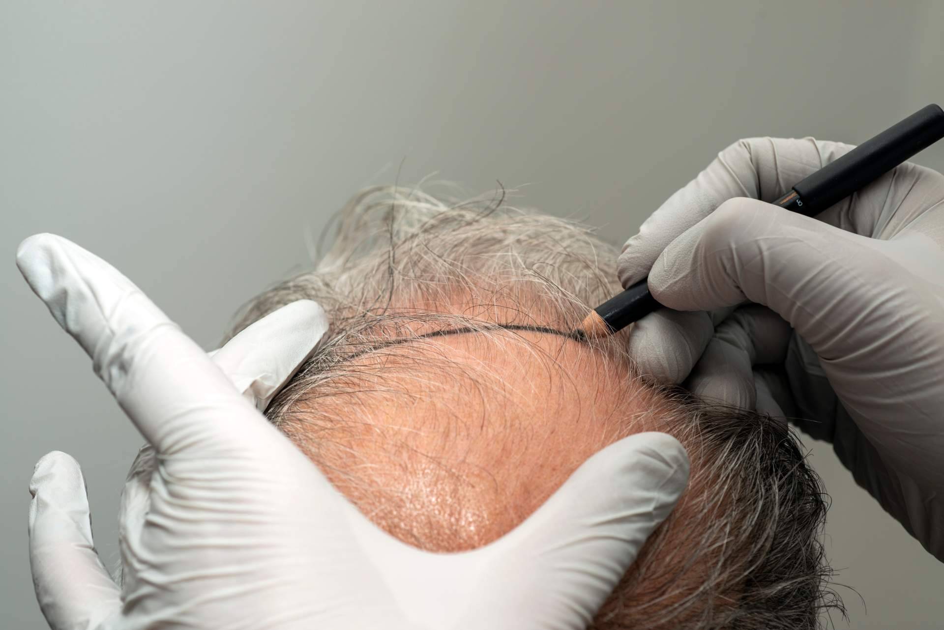 Recuperar el cabello con garantías, la propuesta del Dr. Jesús Aníbal Mora en cirugía capilar